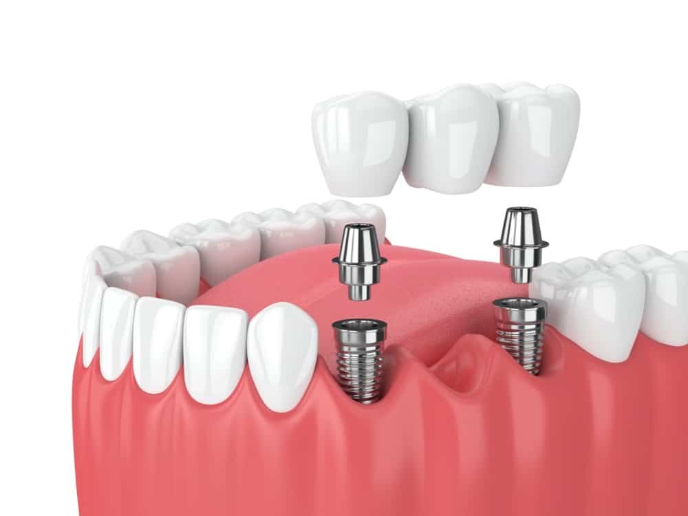 Dental implants Kent